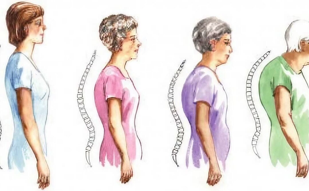 ¿Qué es la hipercifosis dorsal?: Síntomas y tratamiento