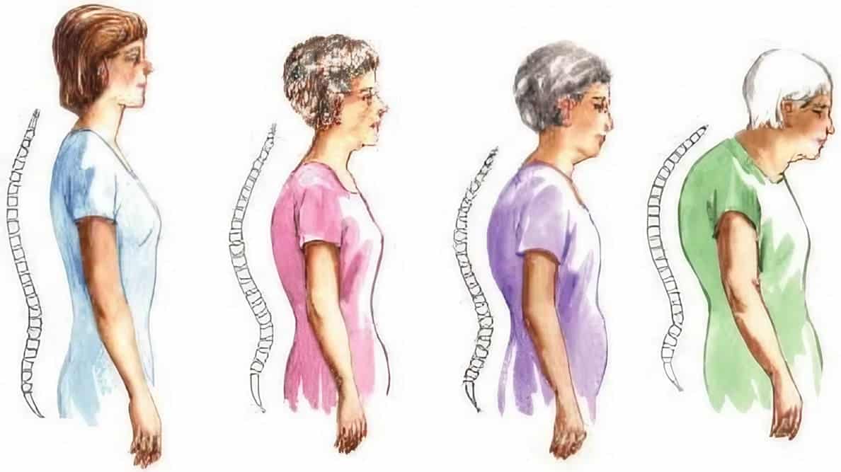 ¿Qué es la hipercifosis dorsal?: Síntomas y tratamiento